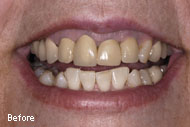 Dental Crowns Before After Pictures